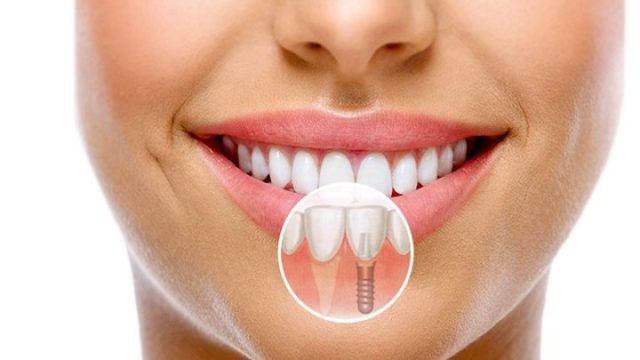 دکتر آرش غفوری متخصص ایمپلنت دندان