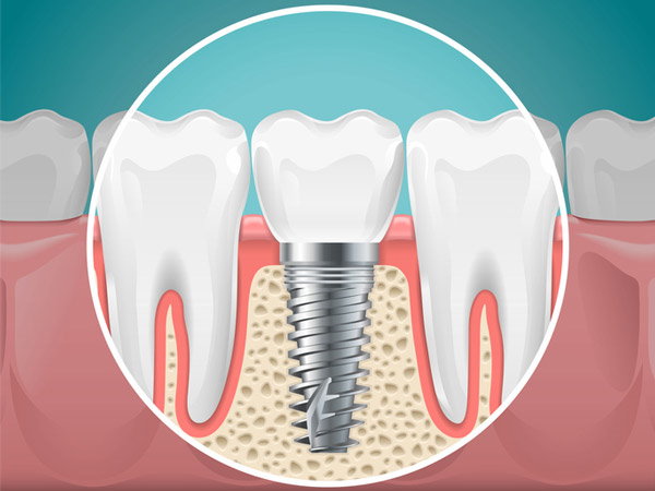 مرکز دندانپزشکی و ایمپلنت شادی