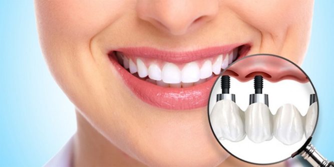 دکتر رضا نوری متخصص ایمپلنت‌ دندان