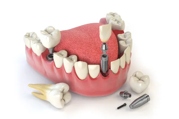 مرکز دندانپزشکی و ایمپلنت ملاصدرا