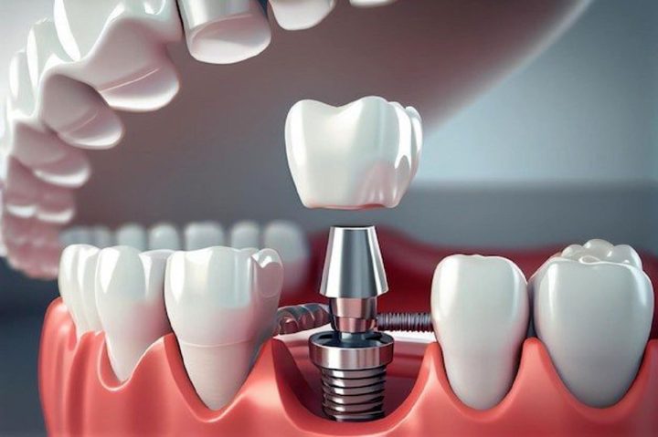 دکتر عزیز گشاده رو متخصص ایمپلنت‌